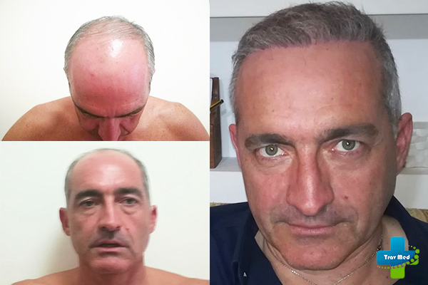 trapianto capelli tirana trav med prima e dopo