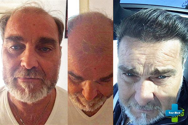 trapianto capelli tirana trav med prima e dopo 2