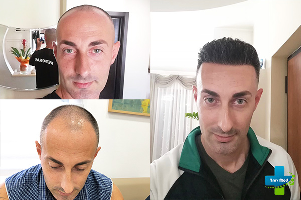 trapianto capelli tirana trav med prima e dopo 2